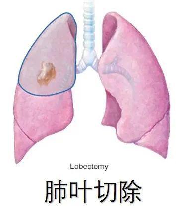 肺结节最新手术标准