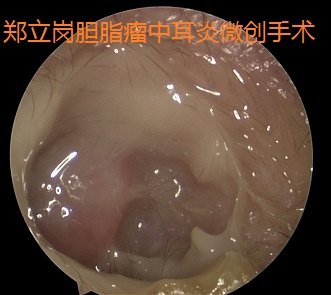 最新胆脂瘤手术价格及其变化,探索学习与自信的力量