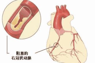 心绞痛的最新分型，时代背景下的深入研究探索