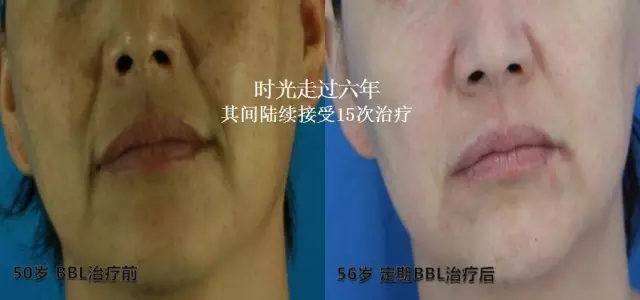 BBL光子嫩肤最新款，变化的力量，自信之源与成就感的体现