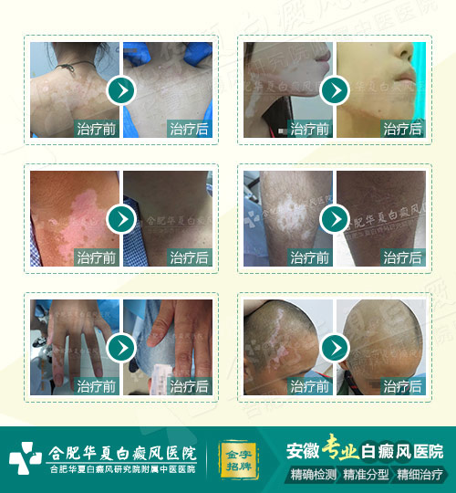 白斑病最新治疗技术，重塑肌肤的希望之光